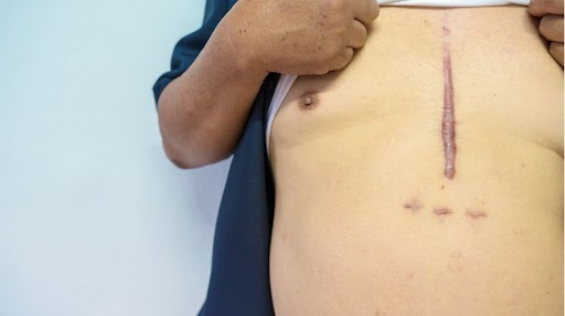 Managing and Healing Open Heart Surgery Scars: A Comprehensive Guide